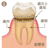 歯周病進行イメージ1