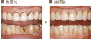 審美歯科症例1