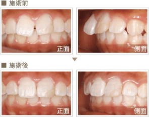 審美歯科症例3