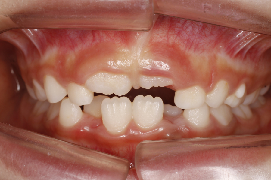 Before