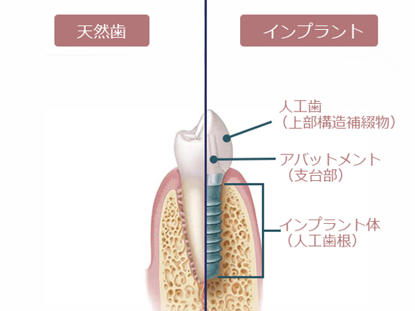 インプラントの構造