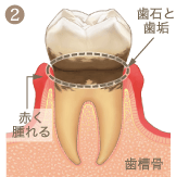 歯周病の進行段階
