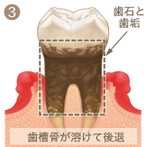 歯周病の重度段階