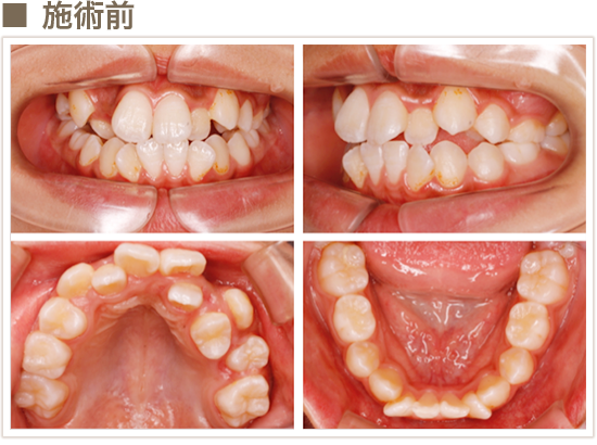 矯正治療例1-1