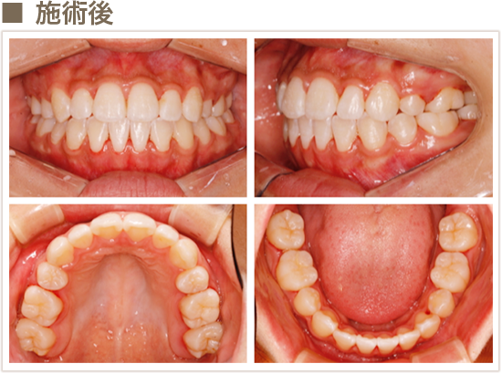 矯正治療例1-2