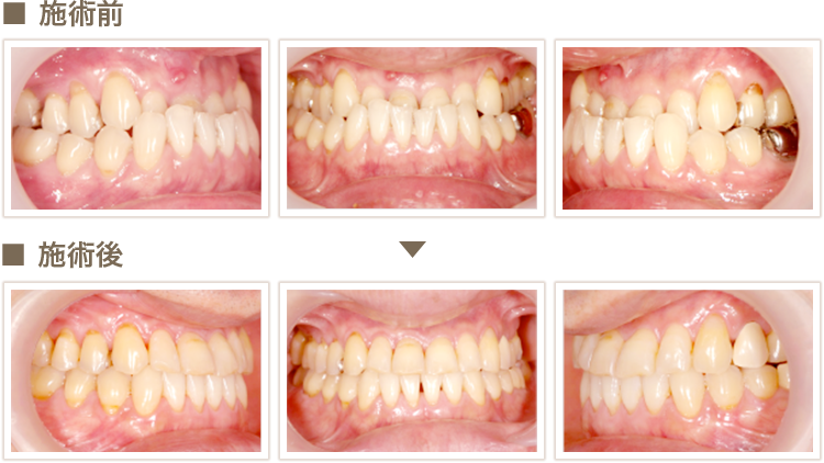 矯正治療例4