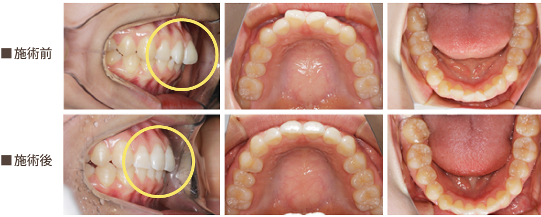 インビザライン症例2