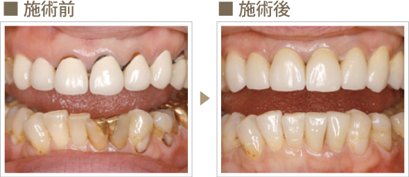 セラミック治療 症例1