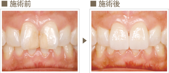 セラミック治療 症例2