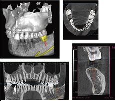 歯科用CTによる治療